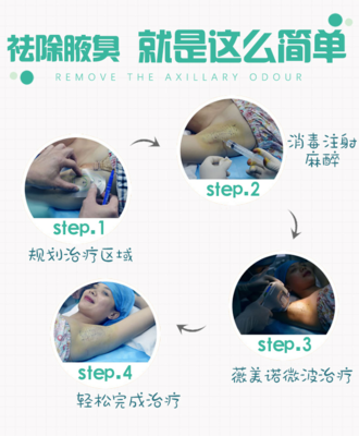 腋臭根源在哪?现在除腋臭正合适