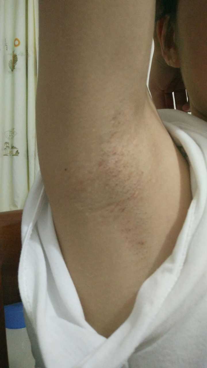 女孩子怎么处理腋臭问题,有风险小的手术治疗吗?