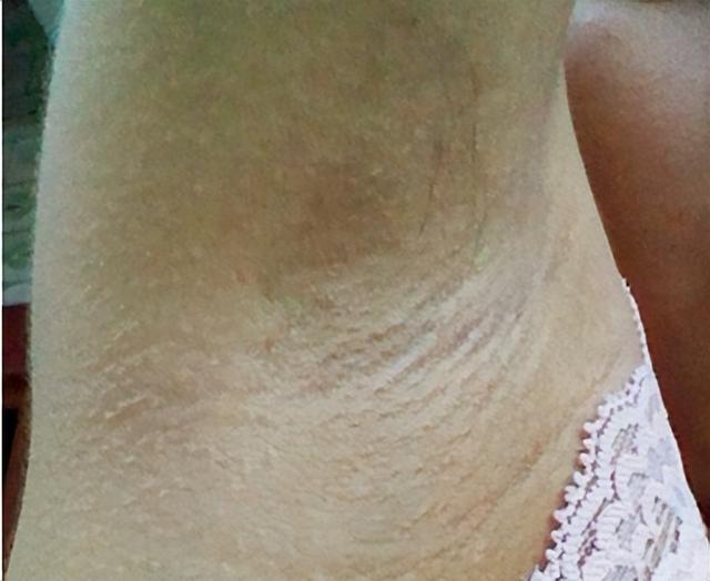 腋臭的人,往往也会伴随着“油耳”?两者到底什么关系?告诉你